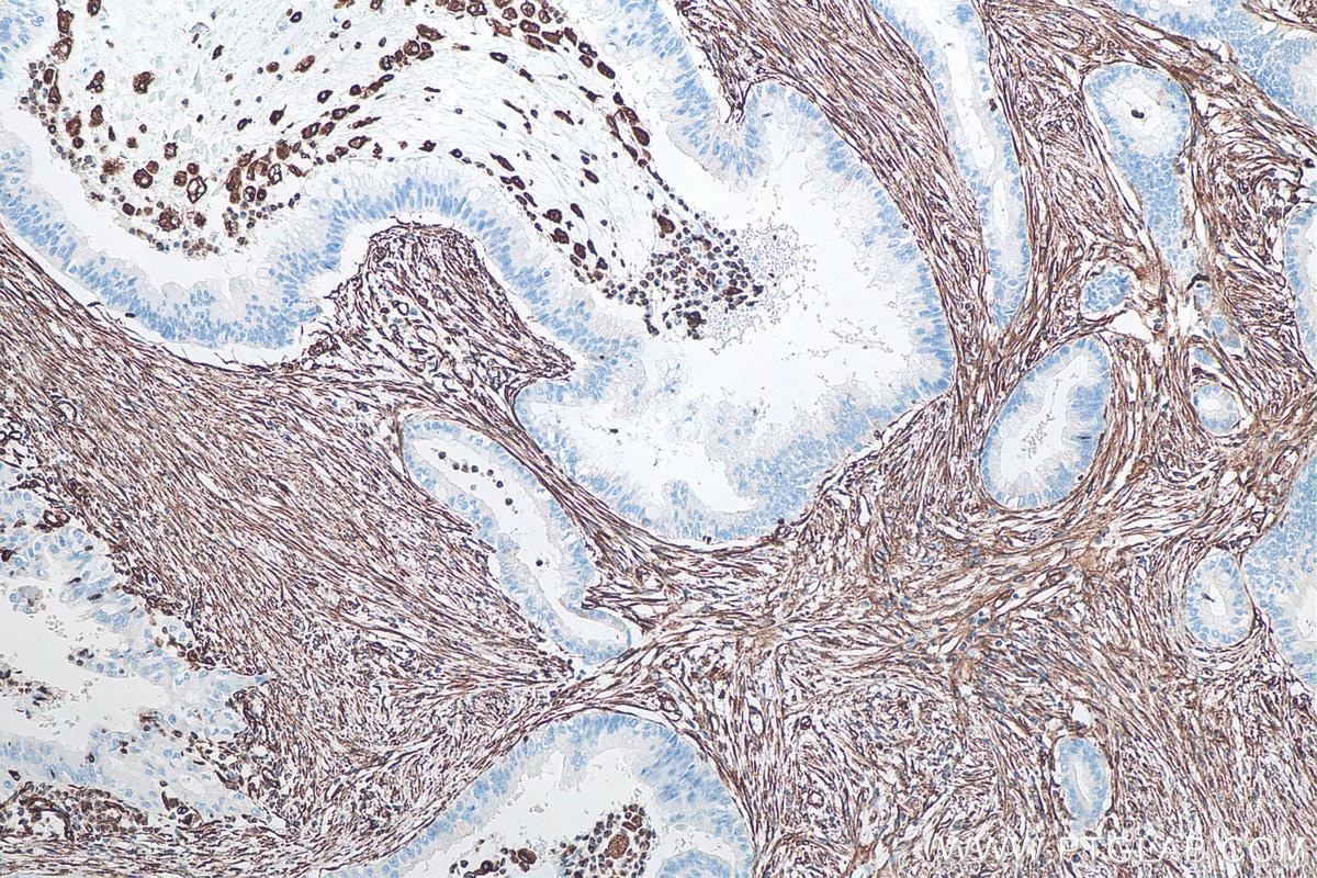 Immunohistochemistry (IHC) staining of human pancreas cancer tissue using Vimentin Monoclonal antibody (60330-1-Ig)
