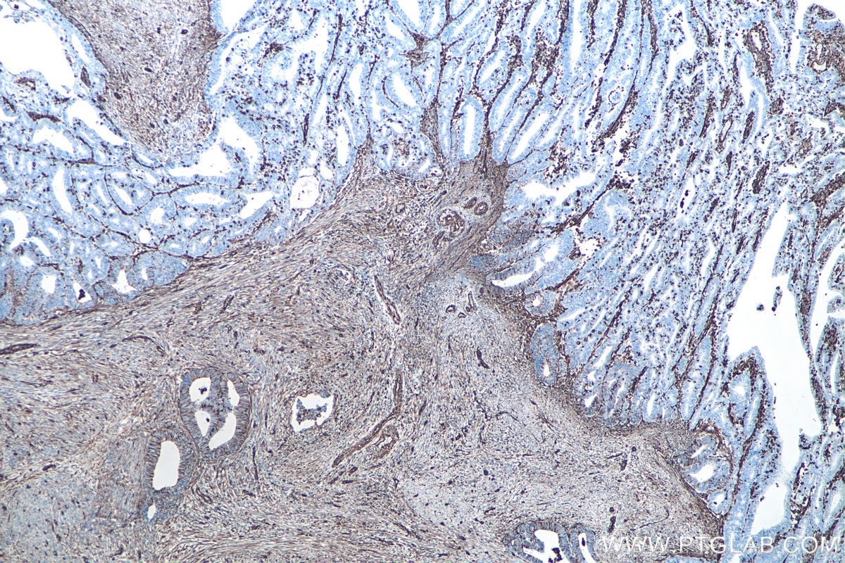 Immunohistochemistry (IHC) staining of human endometrial cancer tissue using Vimentin Monoclonal antibody (60330-1-Ig)