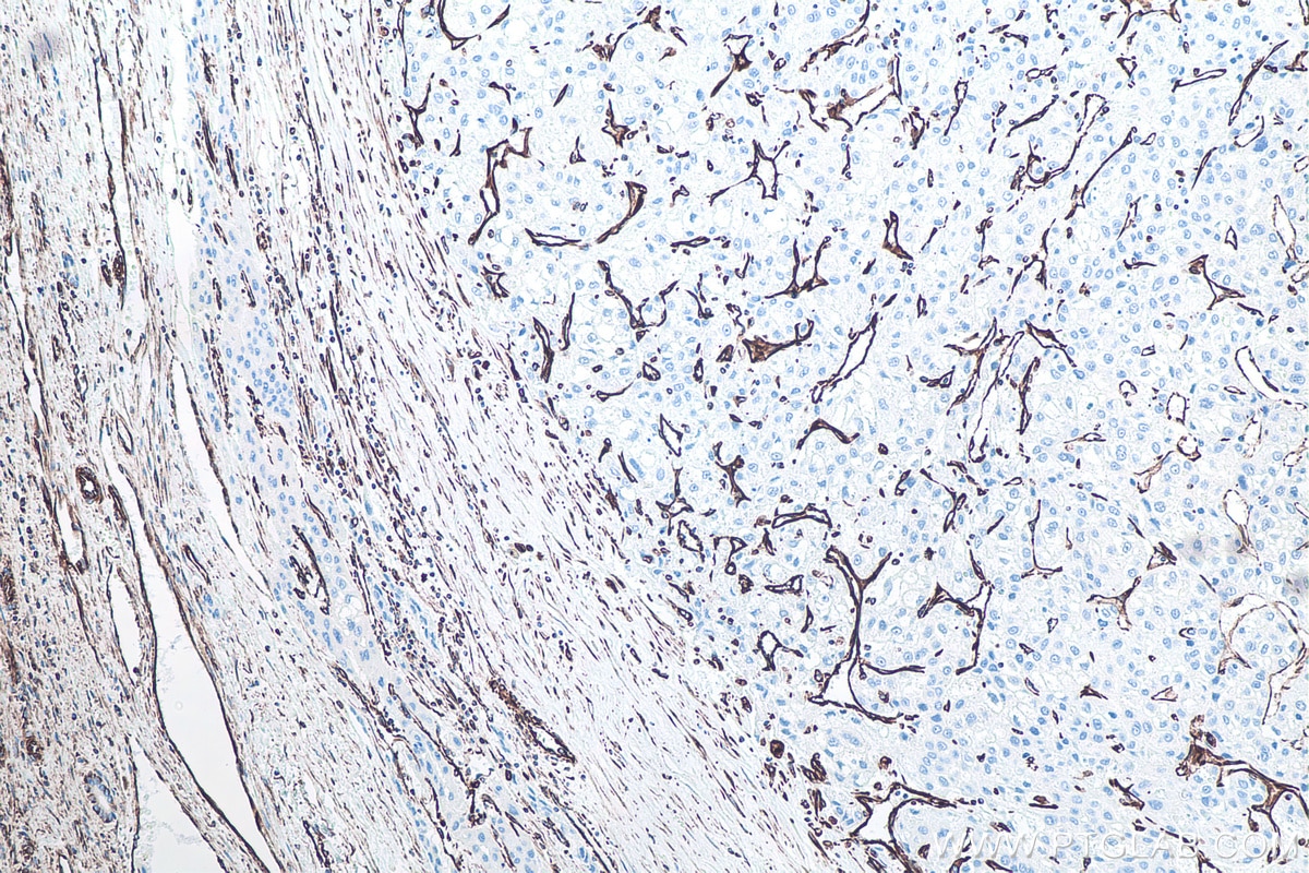 Immunohistochemistry (IHC) staining of human liver cancer tissue using Vimentin Monoclonal antibody (60330-1-Ig)