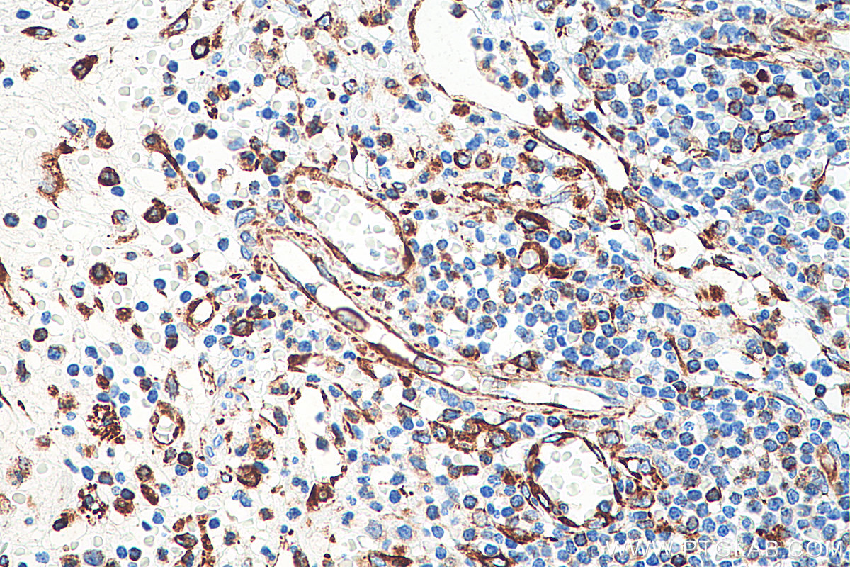 Immunohistochemistry (IHC) staining of human appendicitis tissue using Vimentin Monoclonal antibody (60330-1-Ig)