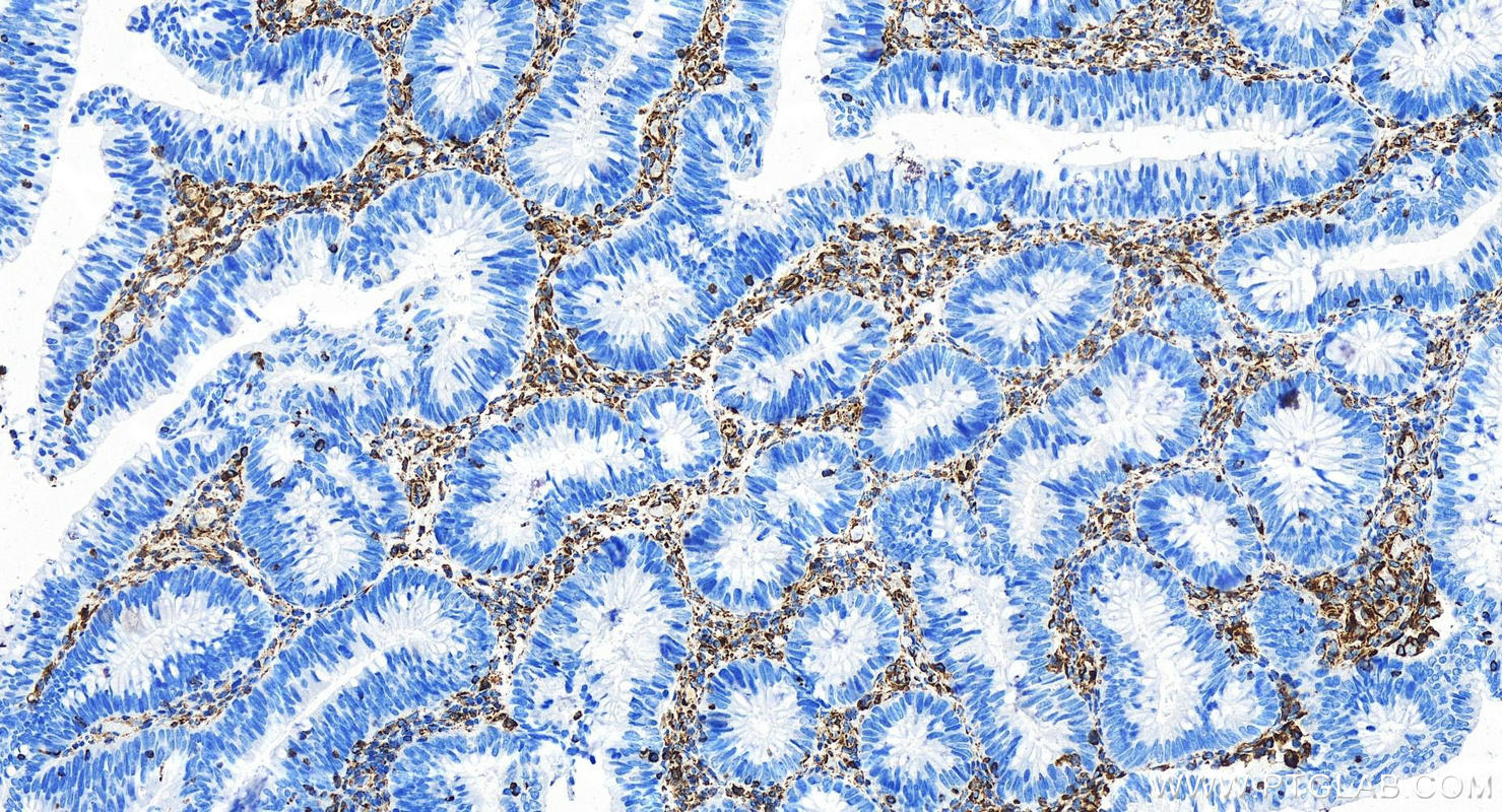 Immunohistochemistry (IHC) staining of human colon cancer tissue using Vimentin Recombinant antibody (80232-1-RR)