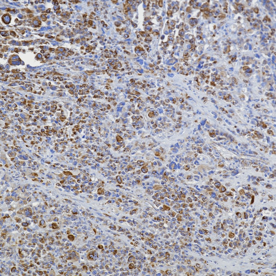 Immunohistochemistry (IHC) staining of human melanoma tissue using Vimentin Recombinant monoclonal antibody (80232-1-RR)