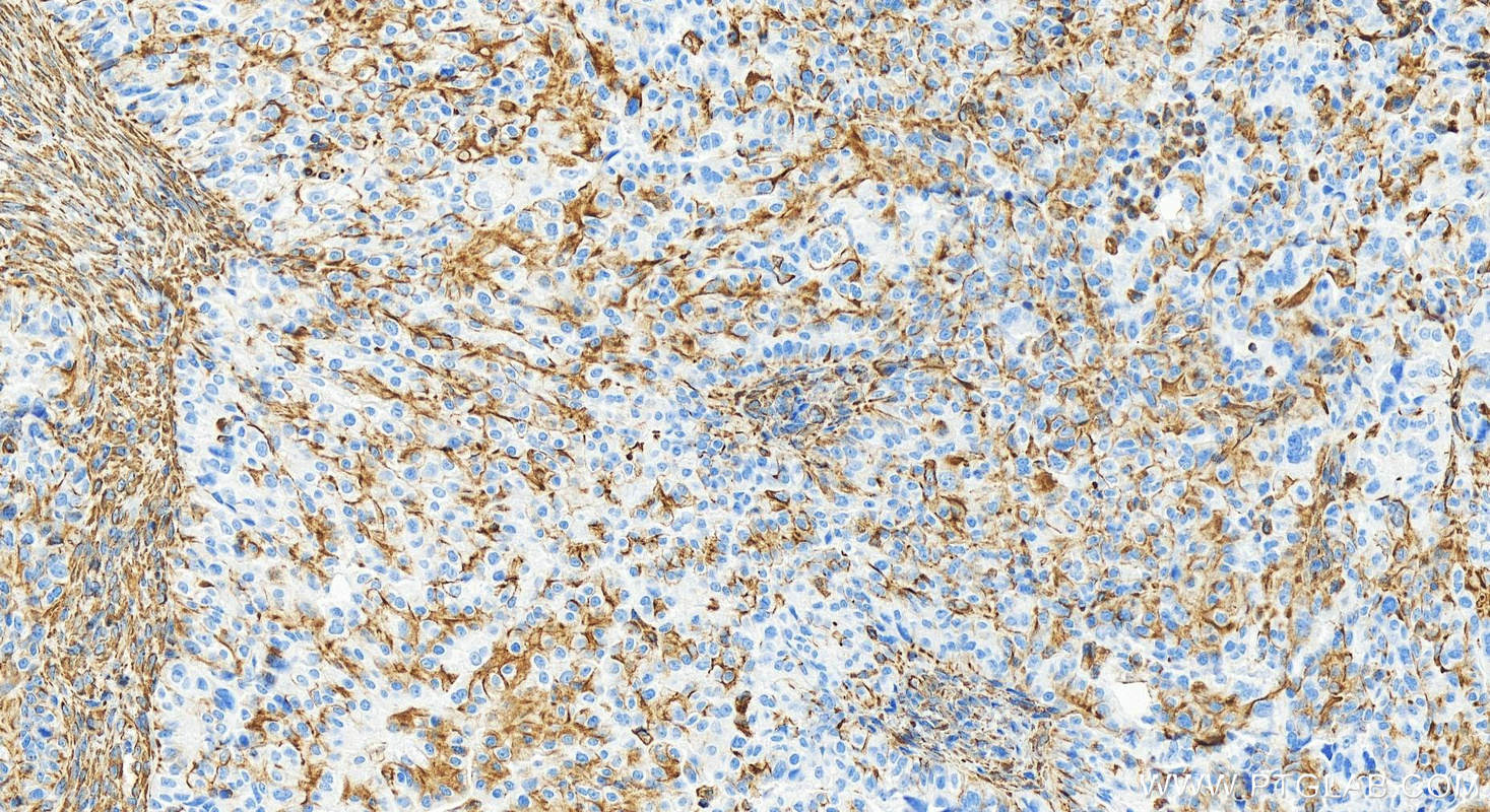 Immunohistochemistry (IHC) staining of human ovary cancer tissue using Vimentin Recombinant antibody (80232-1-RR)