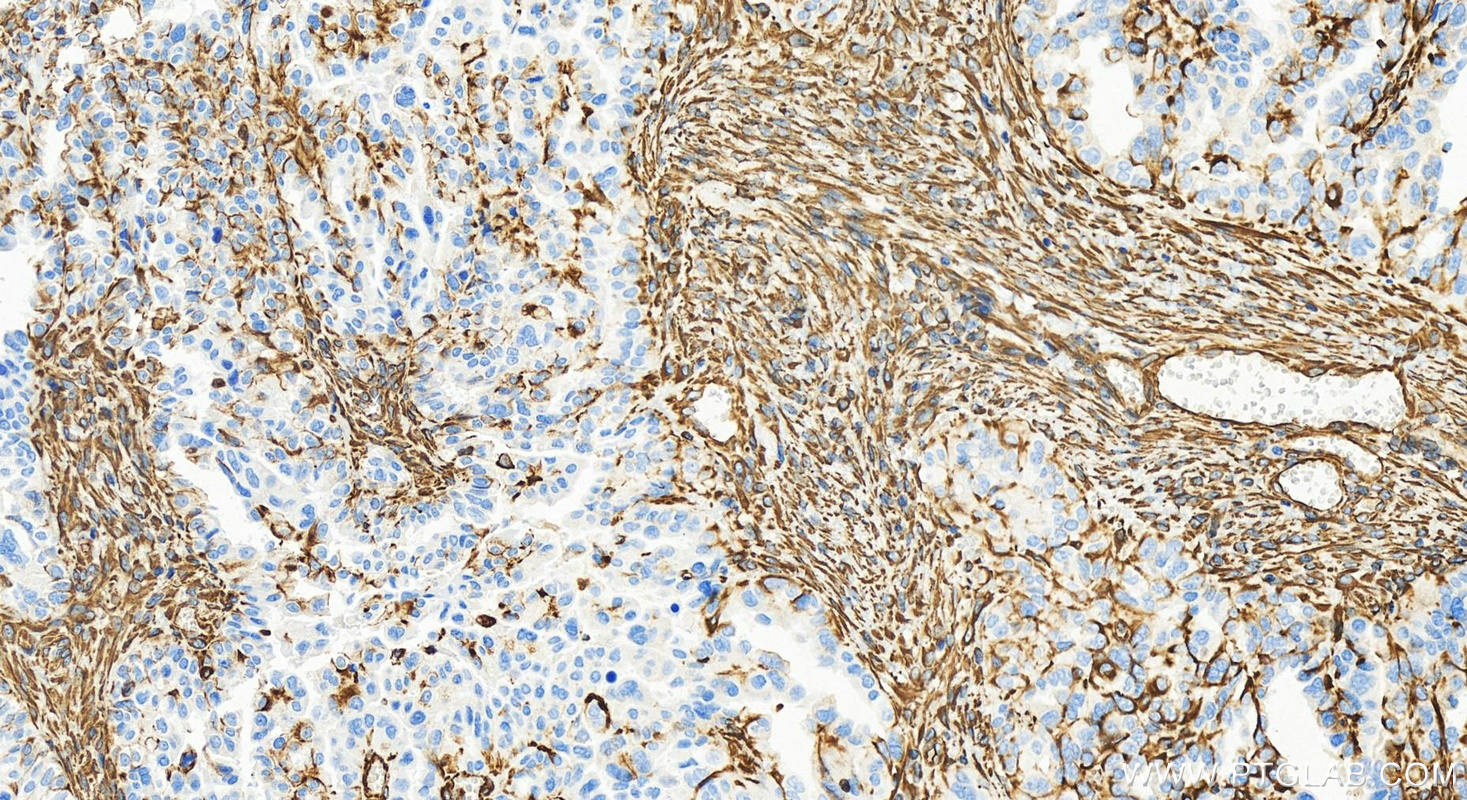 Immunohistochemistry (IHC) staining of human ovary cancer tissue using Vimentin Recombinant antibody (80232-1-RR)