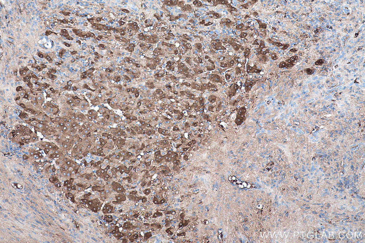 Immunohistochemistry (IHC) staining of human liver cancer tissue using Vitamin D binding protein Monoclonal antibody (66175-1-Ig)