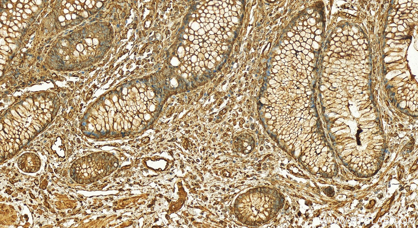 Immunohistochemistry (IHC) staining of human colon cancer tissue using TrpRS Polyclonal antibody (16081-1-AP)