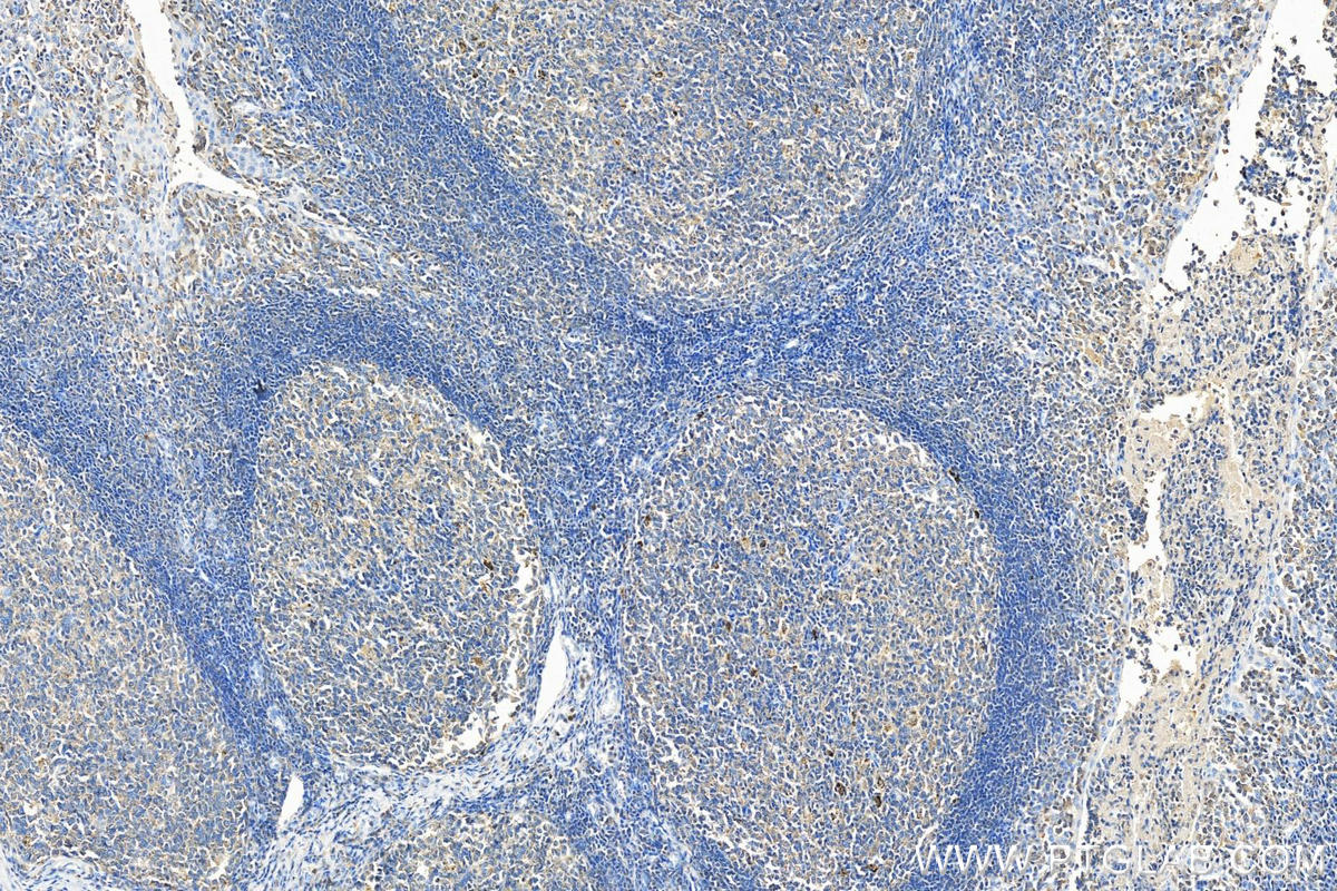 Immunohistochemistry (IHC) staining of human tonsillitis tissue using WASP Polyclonal antibody (10987-1-AP)