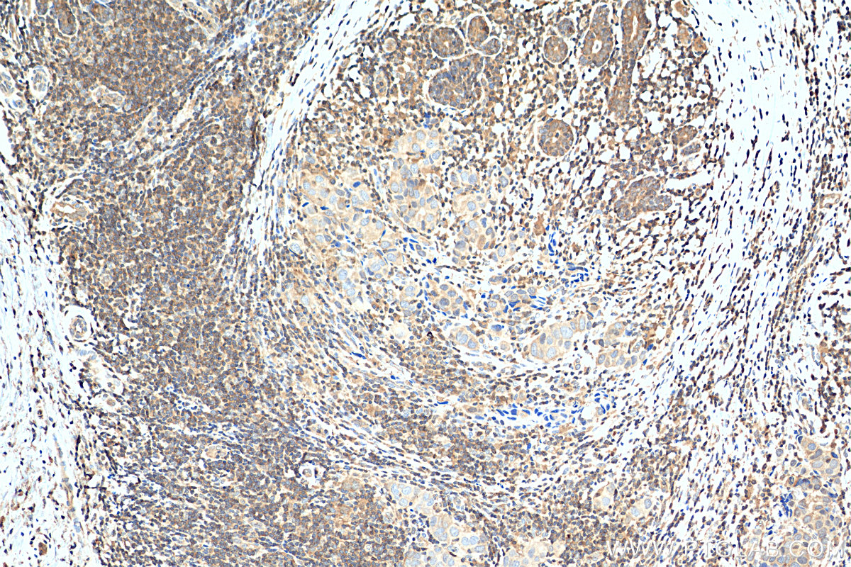 Immunohistochemistry (IHC) staining of human breast cancer tissue using WBP2 Polyclonal antibody (12030-1-AP)