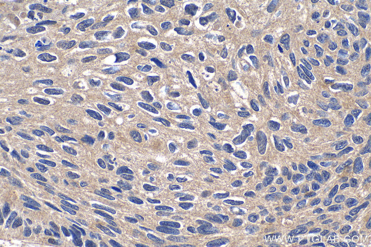 Immunohistochemistry (IHC) staining of human lung cancer tissue using WDR40A Polyclonal antibody (20478-1-AP)