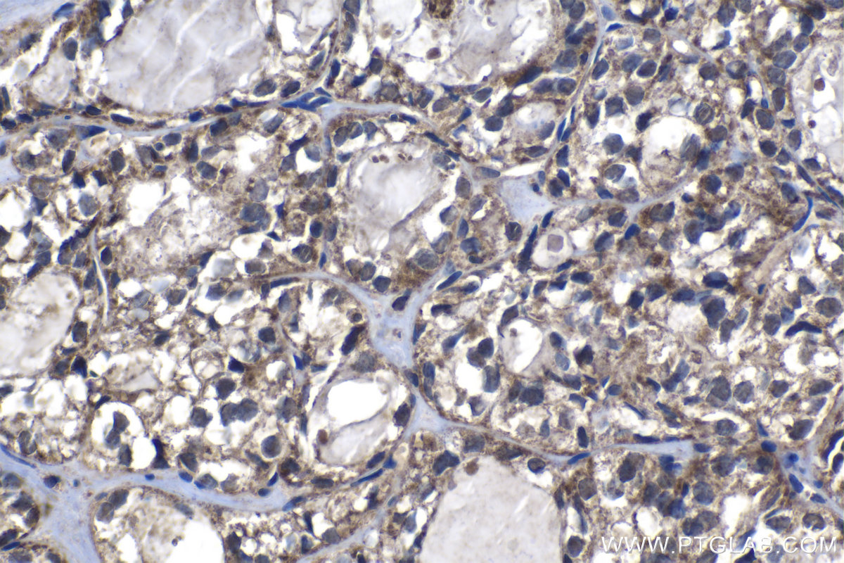 Immunohistochemistry (IHC) staining of human thyroid cancer tissue using WDR40A Polyclonal antibody (20478-1-AP)