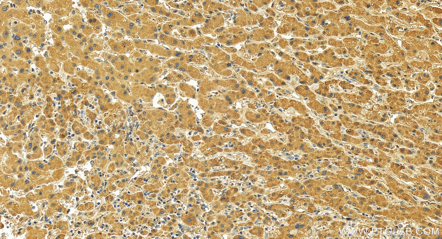 Immunohistochemistry (IHC) staining of human intrahepatic cholangiocarcinoma tissue using WDR48 Polyclonal antibody (16503-1-AP)