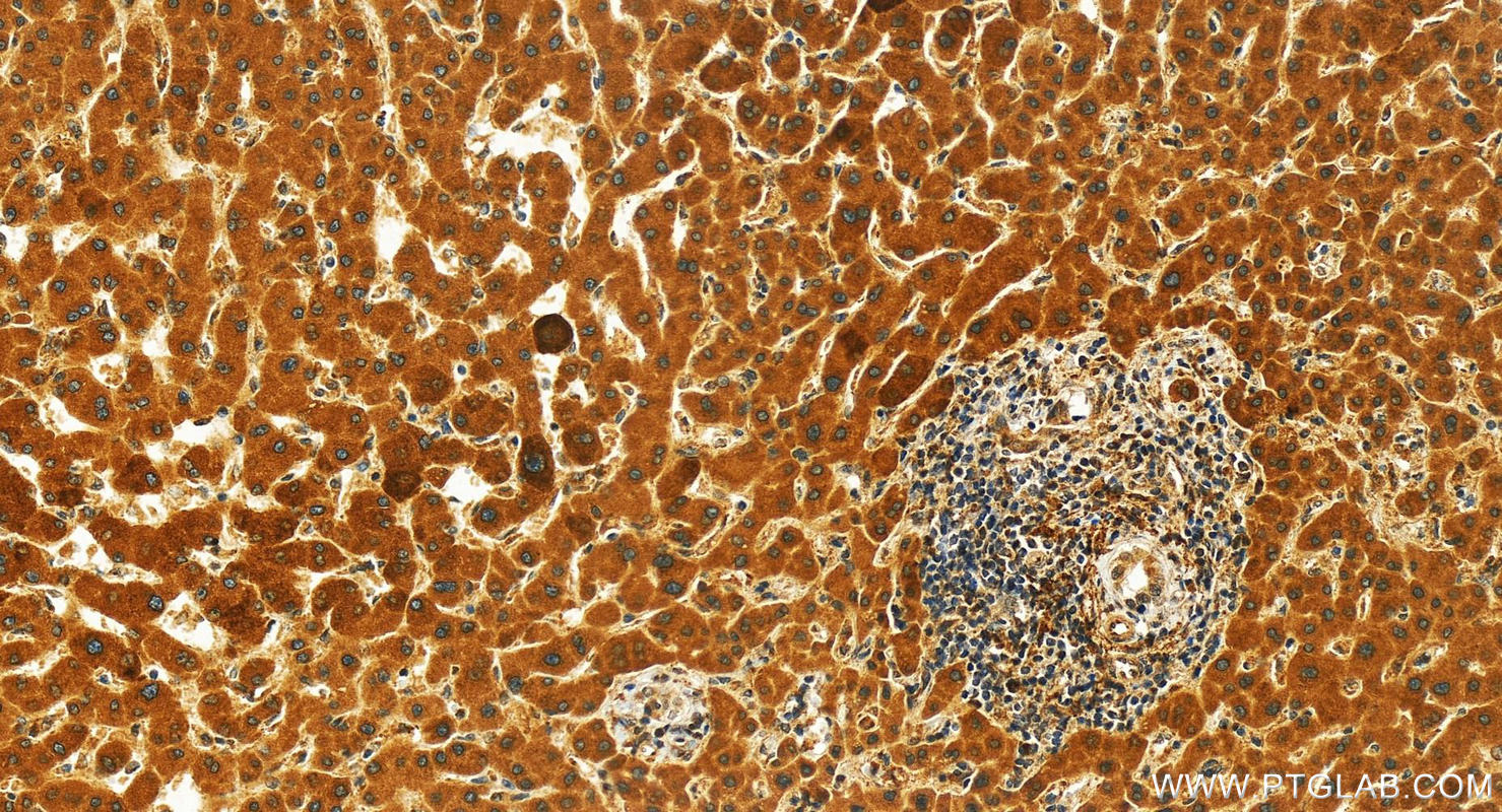 Immunohistochemistry (IHC) staining of human intrahepatic cholangiocarcinoma tissue using WDR6 Polyclonal antibody (20508-1-AP)