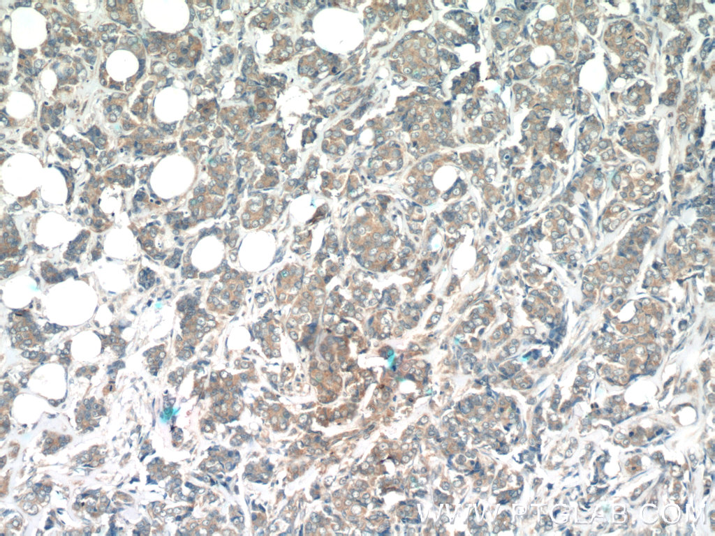 Immunohistochemistry (IHC) staining of human breast cancer tissue using WFDC1 Polyclonal antibody (13204-1-AP)