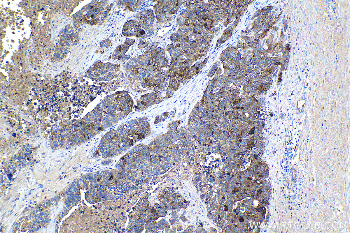 Immunohistochemistry (IHC) staining of human ovary tumor tissue using HE4 Polyclonal antibody (14406-1-AP)