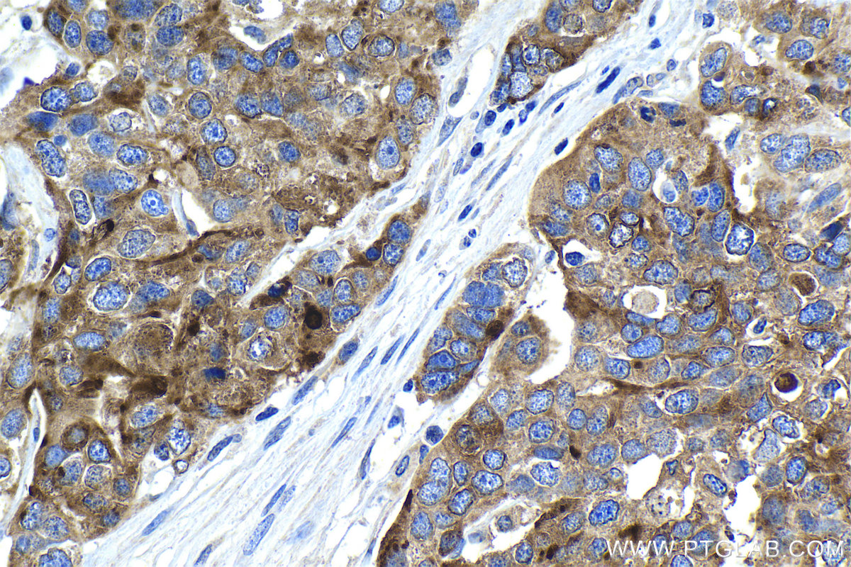 Immunohistochemistry (IHC) staining of human ovary tumor tissue using HE4 Polyclonal antibody (14406-1-AP)