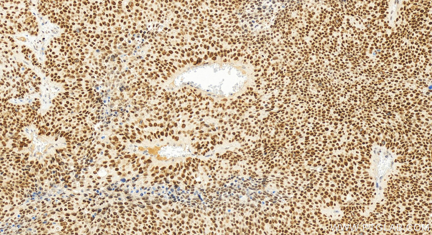 Immunohistochemistry (IHC) staining of human lung squamous cell carcinoma tissue using NSD3 Polyclonal antibody (11345-1-AP)