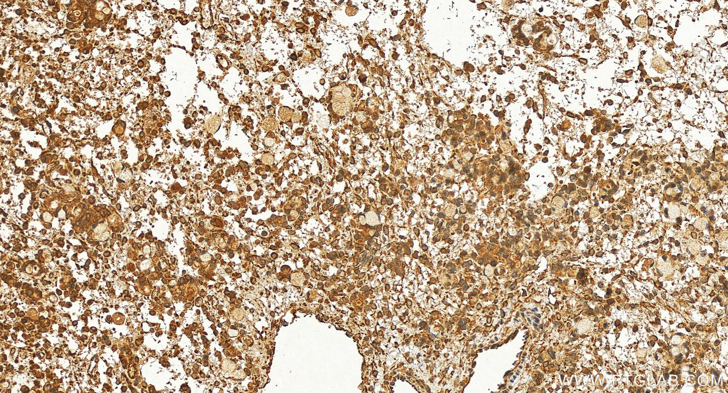 Immunohistochemistry (IHC) staining of human ovary cancer tissue using WIPI1 Polyclonal antibody (25204-1-AP)