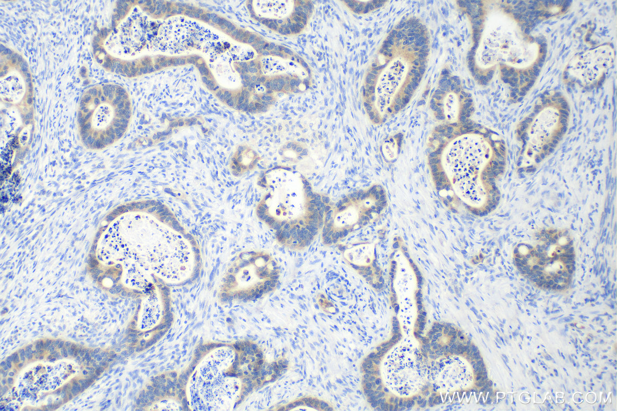 Immunohistochemistry (IHC) staining of human colon cancer tissue using WISP3 Polyclonal antibody (26406-1-AP)