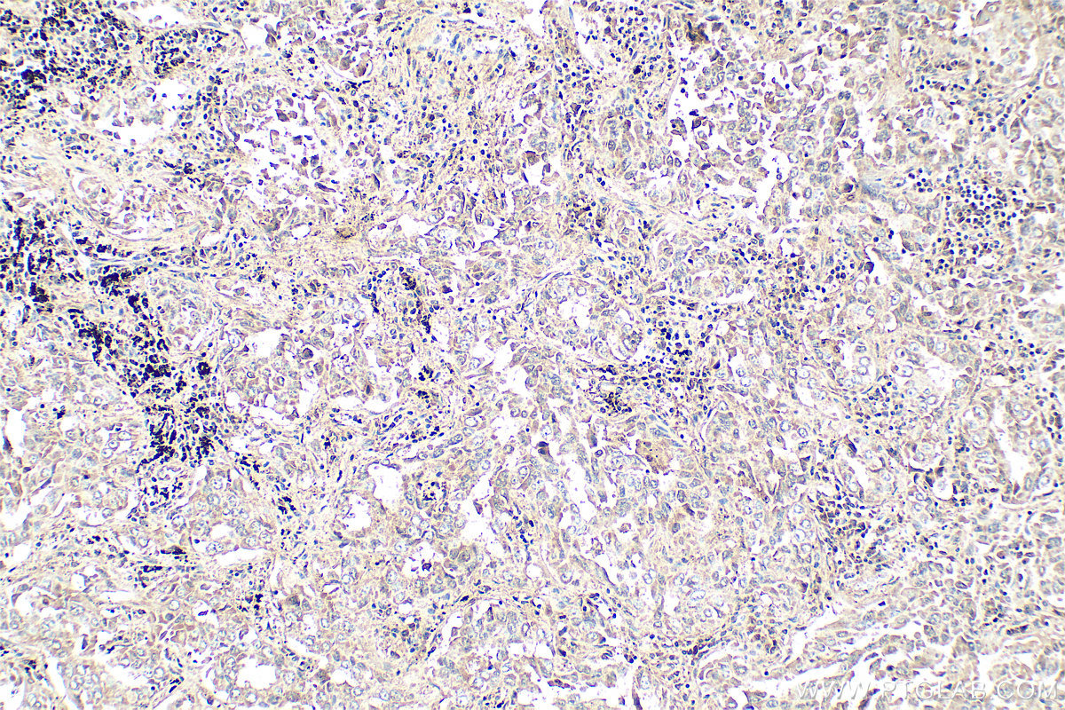 Immunohistochemistry (IHC) staining of human lung cancer tissue using WNT5A/B Polyclonal antibody (29793-1-AP)