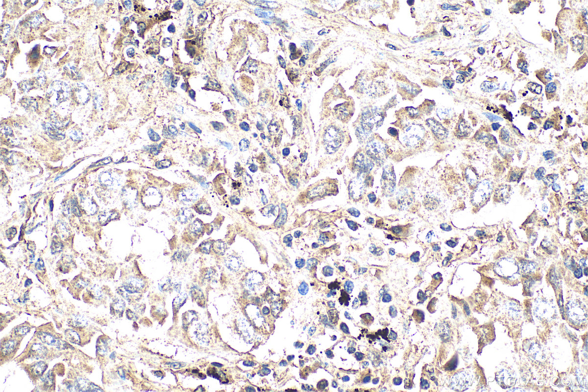 Immunohistochemistry (IHC) staining of human lung cancer tissue using WNT5A/B Polyclonal antibody (29793-1-AP)
