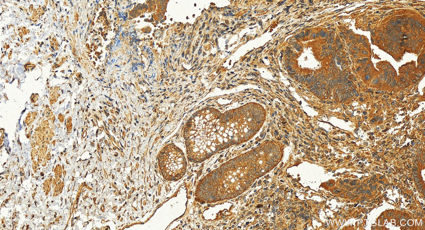 Immunohistochemistry (IHC) staining of human colon cancer tissue using WNT8A Polyclonal antibody (30518-1-AP)