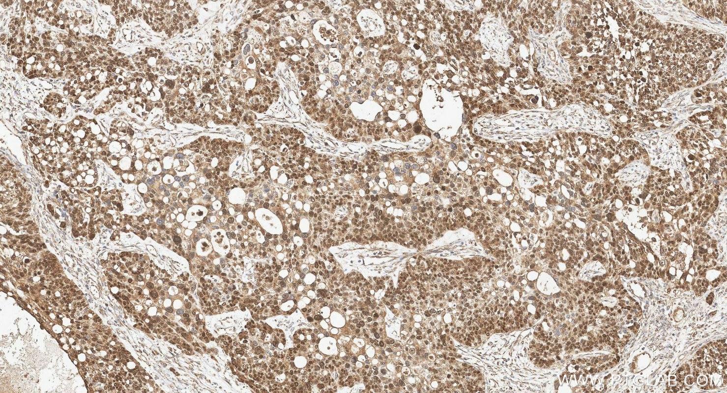 Immunohistochemistry (IHC) staining of human ovary cancer tissue using WT1 Polyclonal antibody (12609-1-AP)