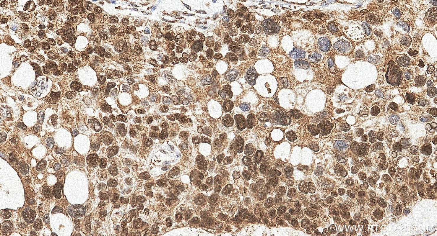 Immunohistochemistry (IHC) staining of human ovary cancer tissue using WT1 Polyclonal antibody (12609-1-AP)