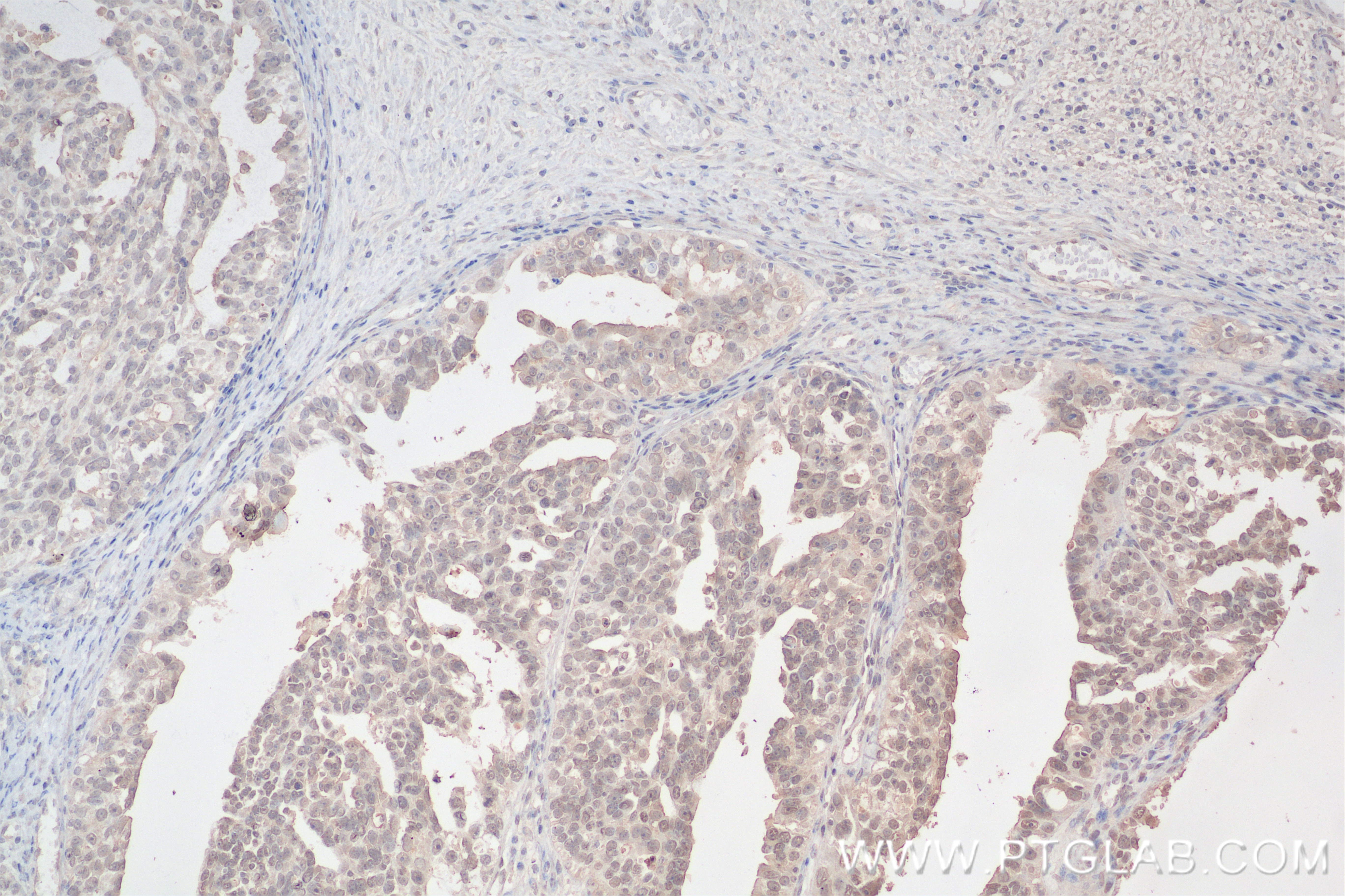 Immunohistochemistry (IHC) staining of human ovary cancer tissue using WT1 Recombinant antibody (82525-1-RR)