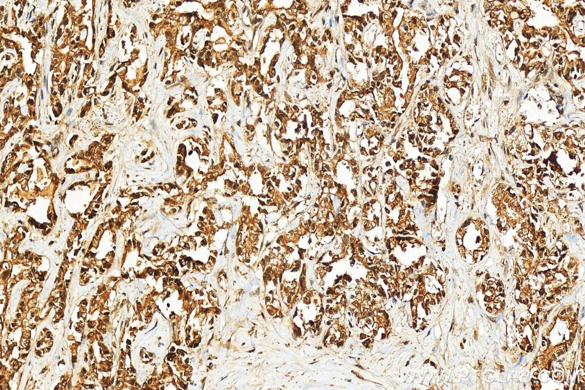 Immunohistochemistry (IHC) staining of human intrahepatic cholangiocarcinoma tissue using WTAP Polyclonal antibody (10200-1-AP)