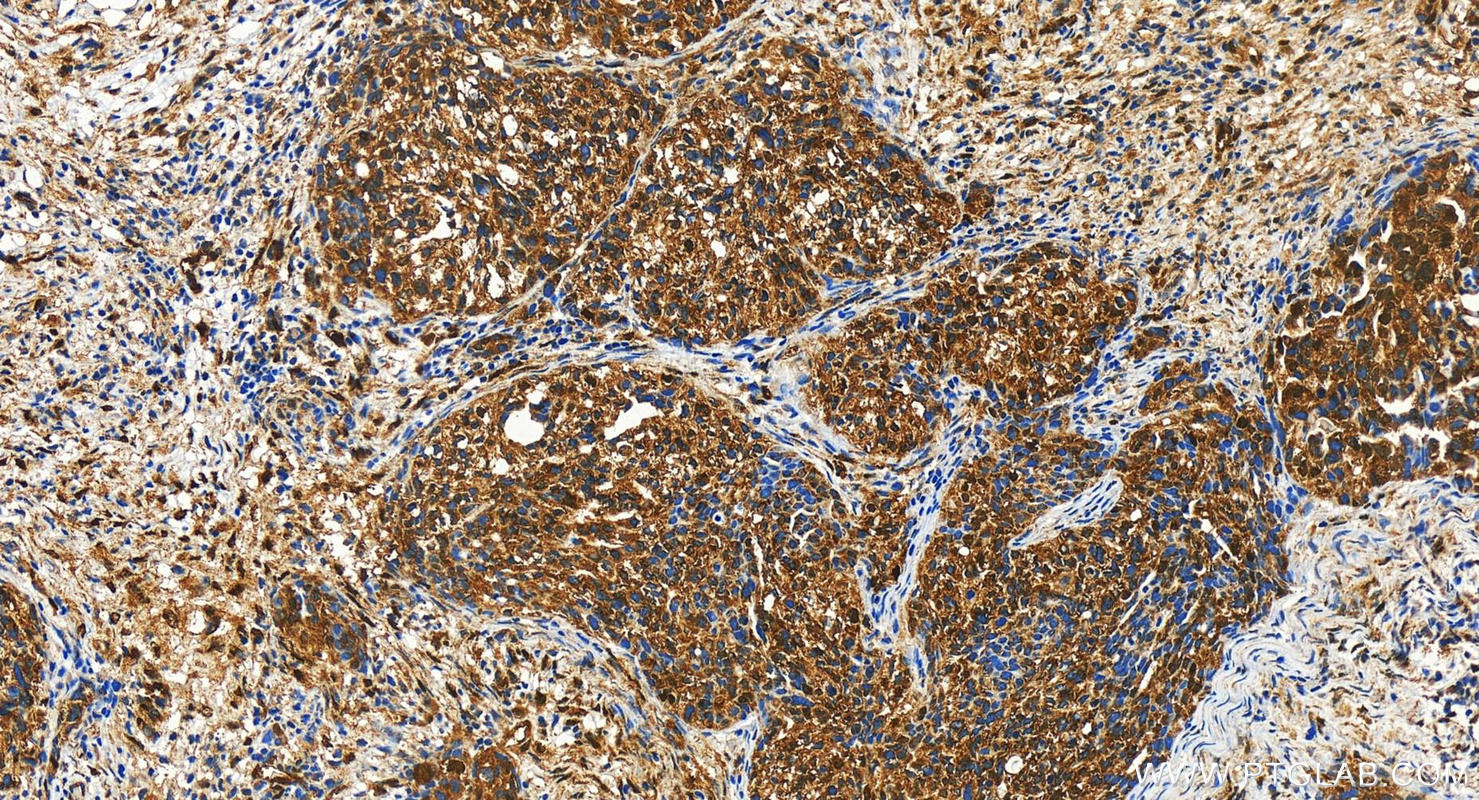 Immunohistochemistry (IHC) staining of human ovary cancer tissue using WWTR1/TAZ Polyclonal antibody (23306-1-AP)