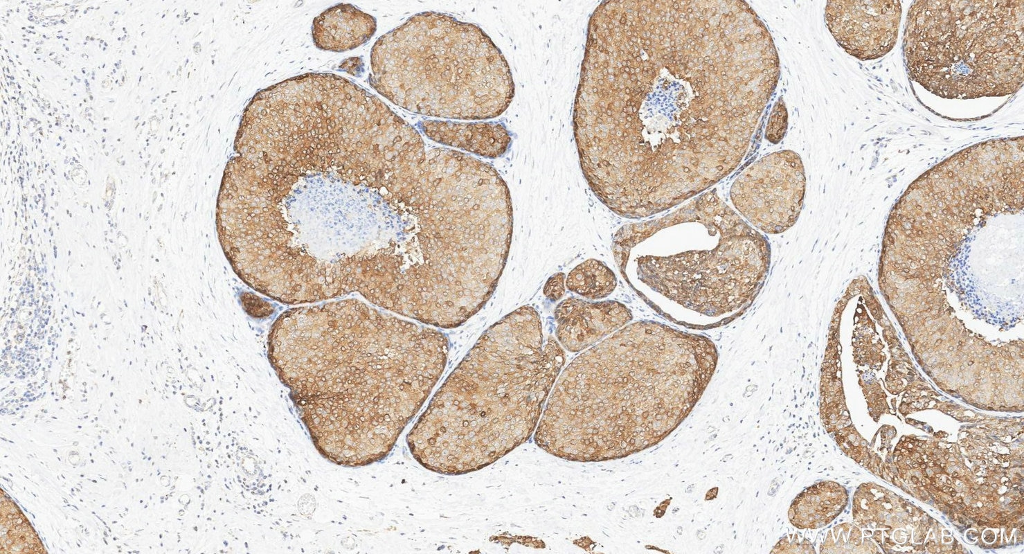 Immunohistochemistry (IHC) staining of human breast cancer tissue using XBP1S-specific Polyclonal antibody (24868-1-AP)