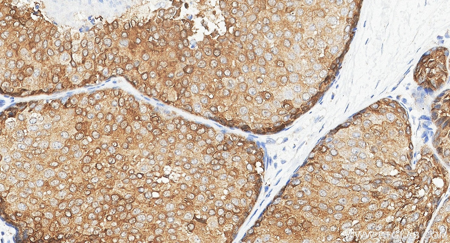 Immunohistochemistry (IHC) staining of human breast cancer tissue using XBP1S-specific Polyclonal antibody (24868-1-AP)