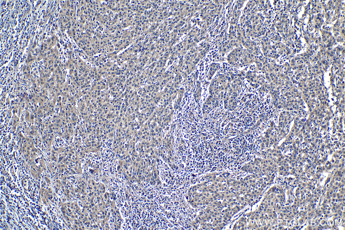 Immunohistochemistry (IHC) staining of human cervical cancer tissue using CRM1 Monoclonal antibody (66763-1-Ig)