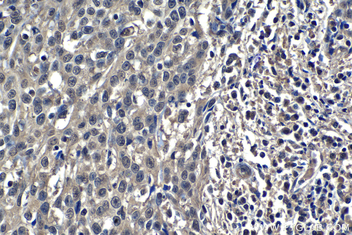 Immunohistochemistry (IHC) staining of human cervical cancer tissue using CRM1 Monoclonal antibody (66763-1-Ig)