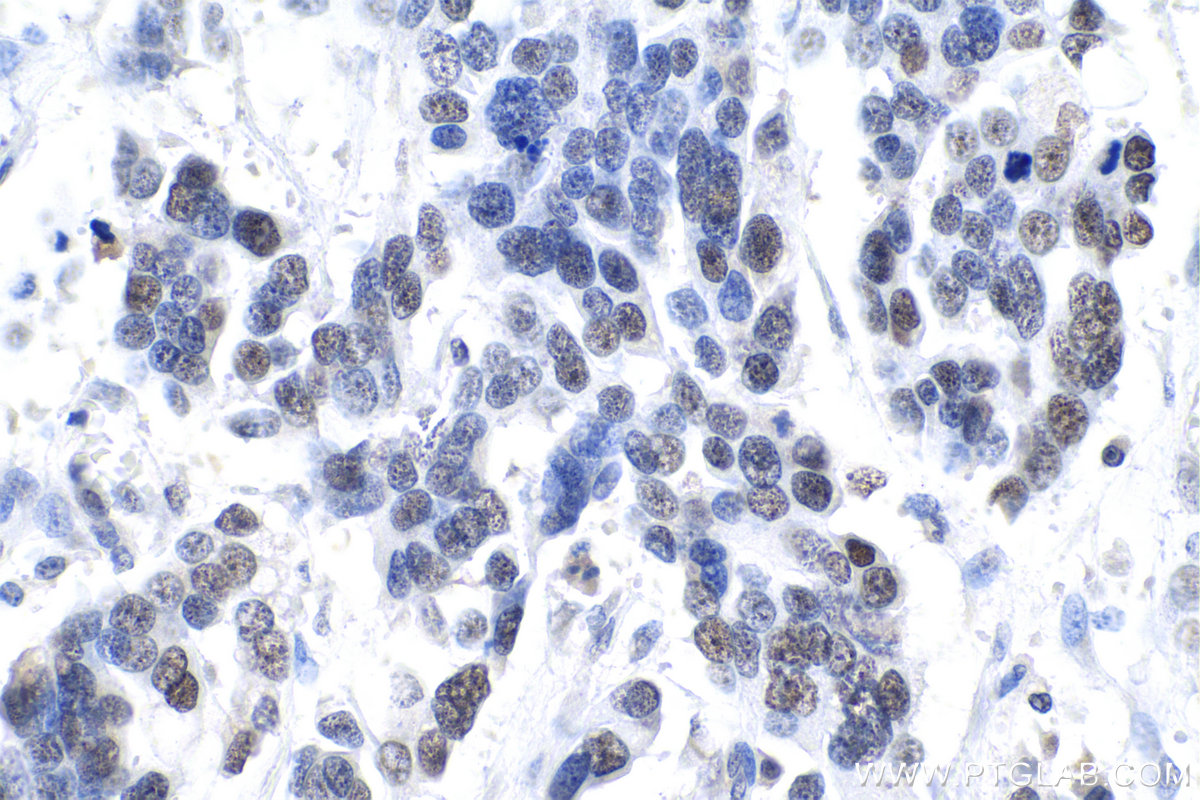 Immunohistochemistry (IHC) staining of human colon cancer tissue using XRCC1 Polyclonal antibody (21468-1-AP)