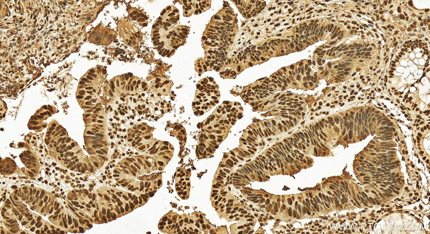 Immunohistochemistry (IHC) staining of human colon cancer tissue using XRCC5/Ku80 Polyclonal antibody (16389-1-AP)