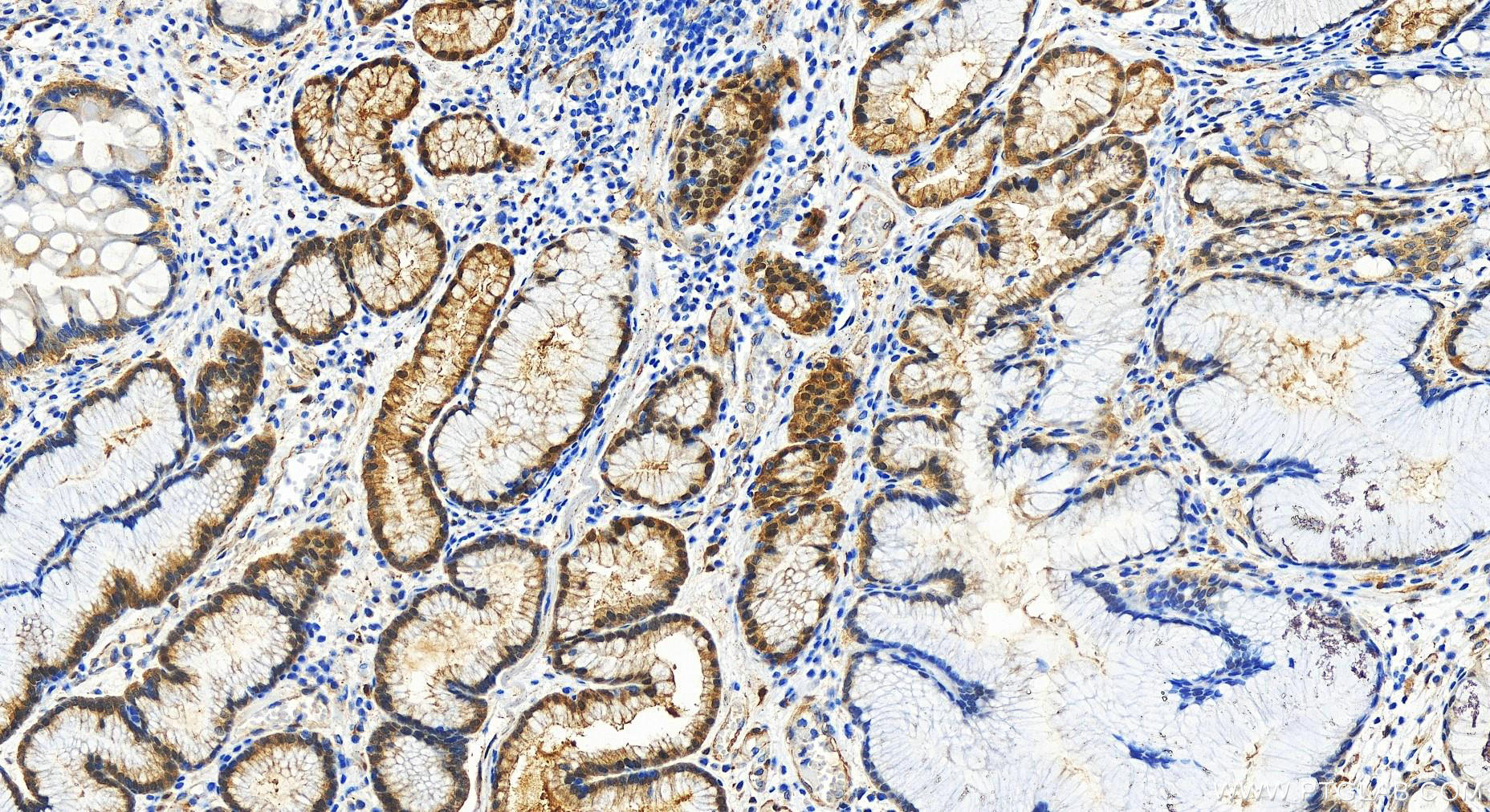 Immunohistochemistry (IHC) staining of human stomach cancer tissue using YAP1 Polyclonal antibody (30464-1-AP)