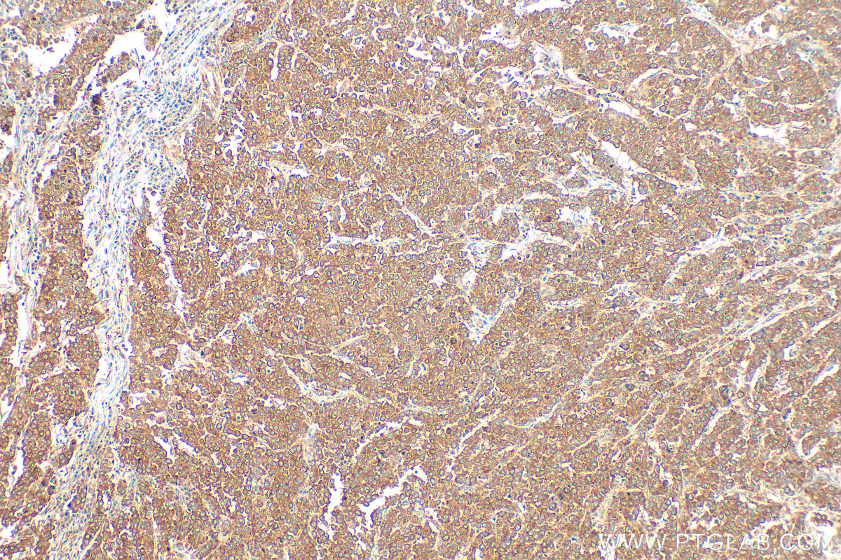 Immunohistochemistry (IHC) staining of human colon cancer tissue using YBX1 Polyclonal antibody (20339-1-AP)