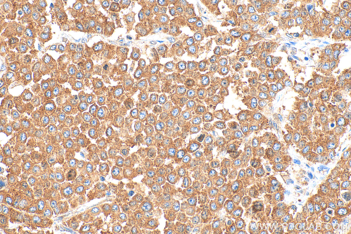 Immunohistochemistry (IHC) staining of human colon cancer tissue using YBX1 Polyclonal antibody (20339-1-AP)