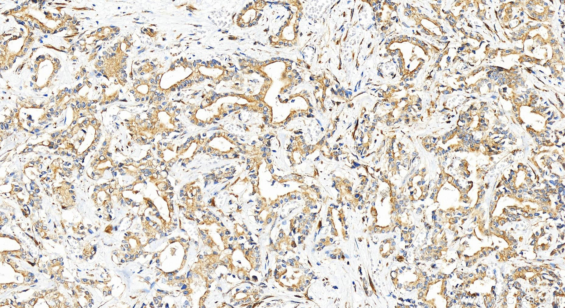 Immunohistochemistry (IHC) staining of human intrahepatic cholangiocarcinoma tissue using YIPF5 Polyclonal antibody (12931-1-AP)