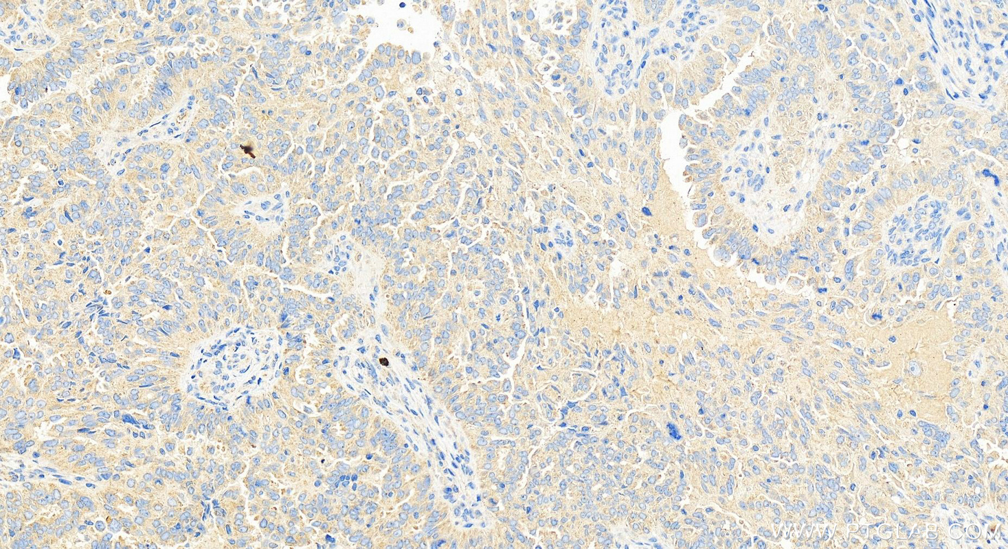 Immunohistochemistry (IHC) staining of human ovary cancer tissue using YIPF5 Polyclonal antibody (12931-1-AP)