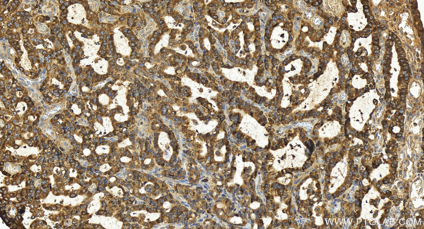 Immunohistochemistry (IHC) staining of human stomach cancer tissue using YTHDC2 Polyclonal antibody (27779-1-AP)