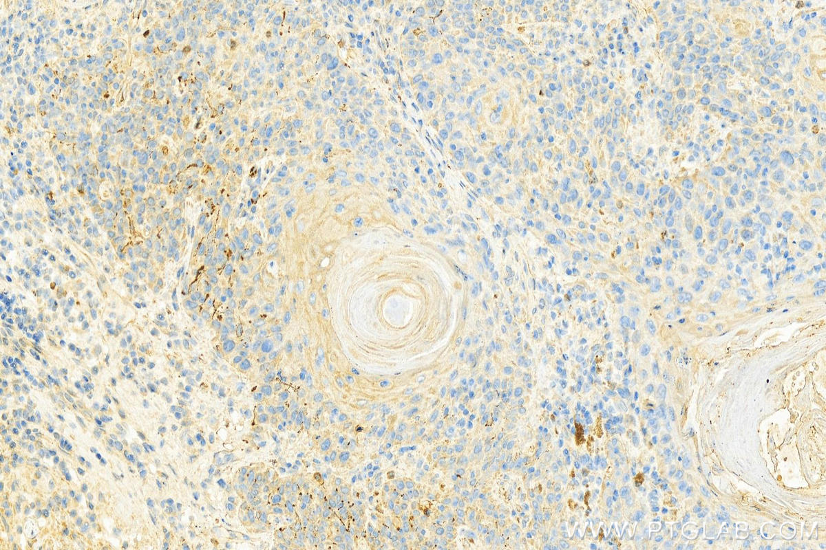 Immunohistochemistry (IHC) staining of human skin cancer tissue using YWHAH Polyclonal antibody (15222-1-AP)