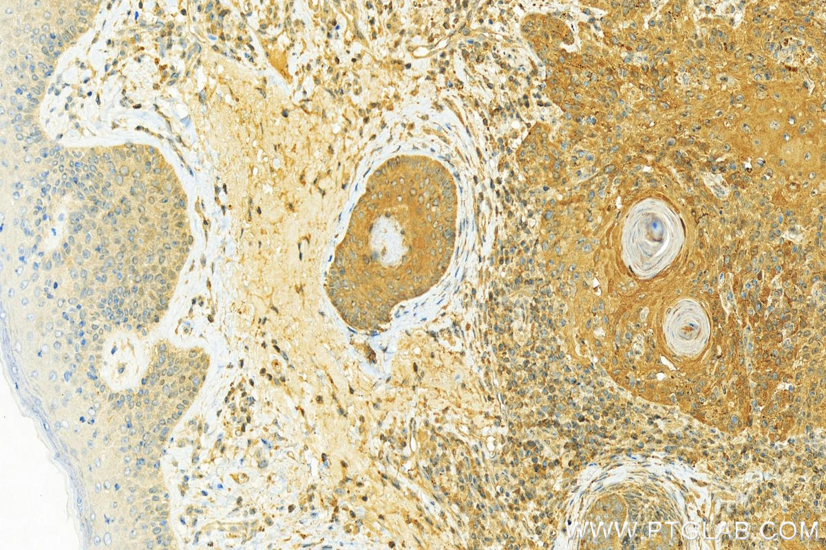 Immunohistochemistry (IHC) staining of human skin cancer tissue using YWHAZ Polyclonal antibody (14881-1-AP)