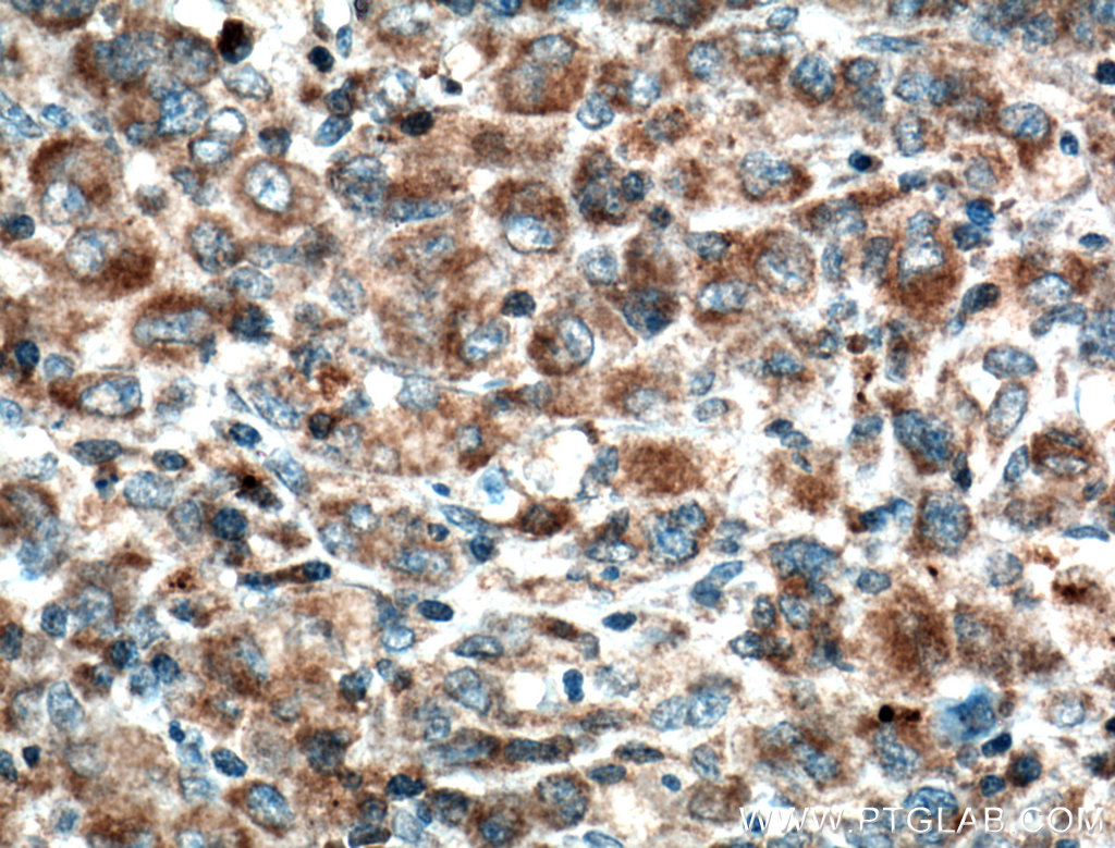 Immunohistochemistry (IHC) staining of human lymphoma tissue using ZAP70 Monoclonal antibody (60200-1-Ig)