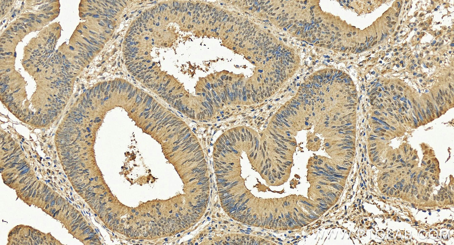 Immunohistochemistry (IHC) staining of human colon cancer tissue using ZBP1 Recombinant antibody (84396-2-RR)