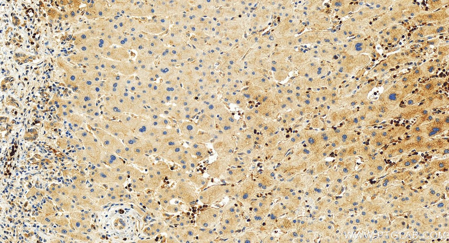 Immunohistochemistry (IHC) staining of human intrahepatic cholangiocarcinoma tissue using ZBTB33 Polyclonal antibody (55270-1-AP)