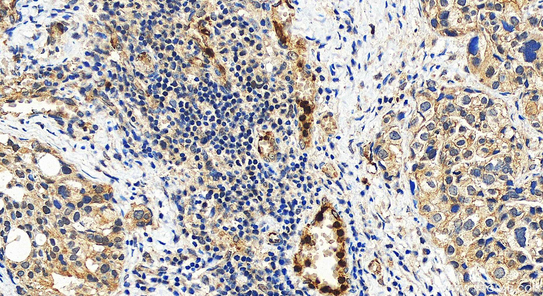 Immunohistochemistry (IHC) staining of human ovary cancer tissue using ZBTB33 Polyclonal antibody (55270-1-AP)