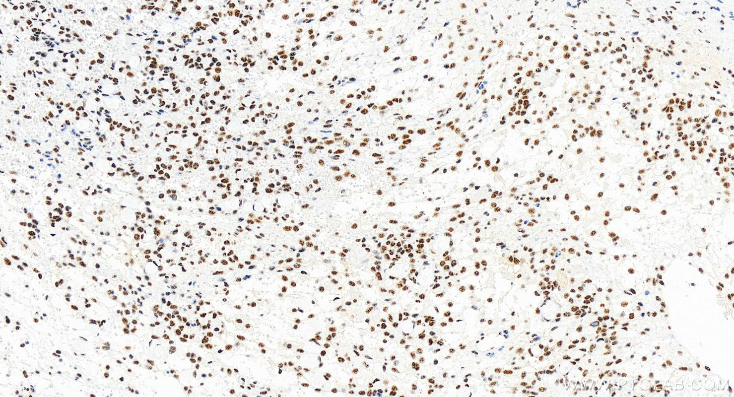 Immunohistochemistry (IHC) staining of human ovary cancer tissue using ZC3H11A Recombinant antibody (82912-1-RR)