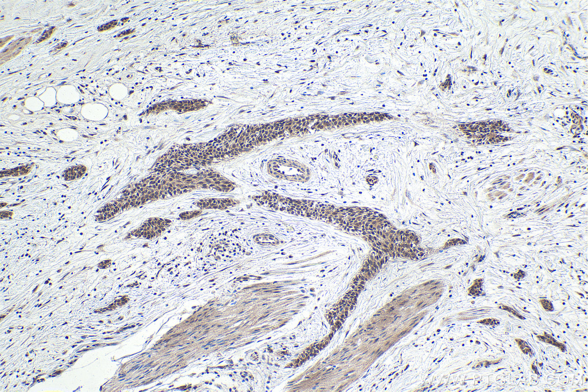 Immunohistochemistry (IHC) staining of human urothelial carcinoma tissue using ZC3H12A Polyclonal antibody (25009-1-AP)